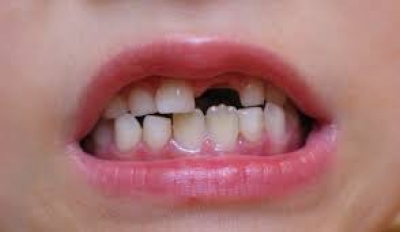 Криви зъби при деца