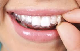 Как да изправим кривите зъби без шини?